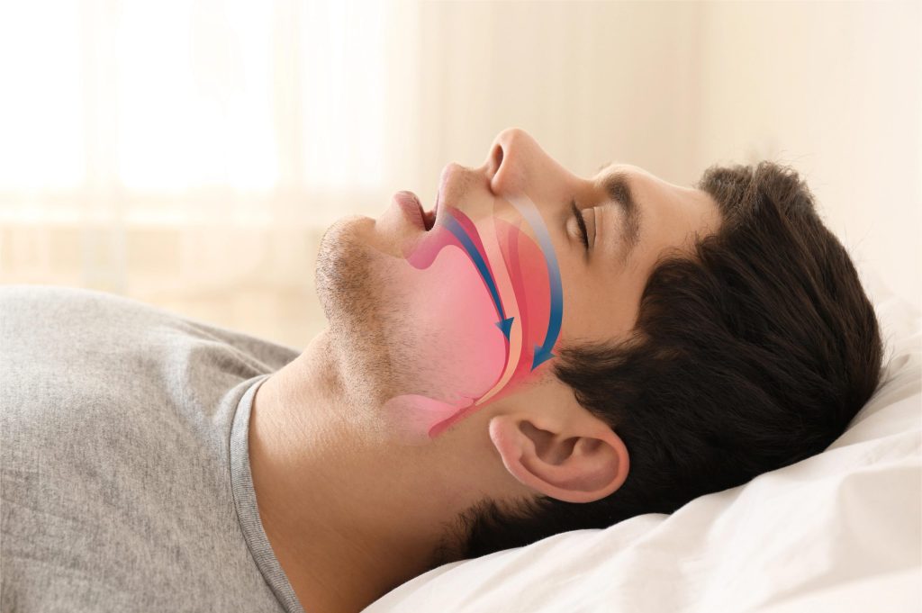 Louisville About Sleep Apnea